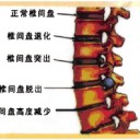 腰椎間盤突出