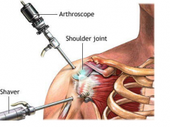 肩關節(jié)鏡手術(shù)